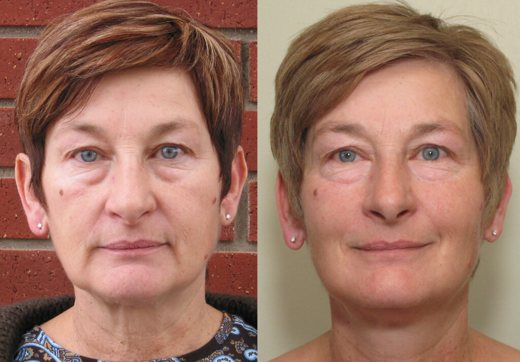 микротоковая терапия для лица до и после