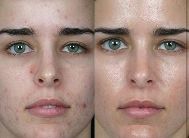 гидропилинг лица фото до и после