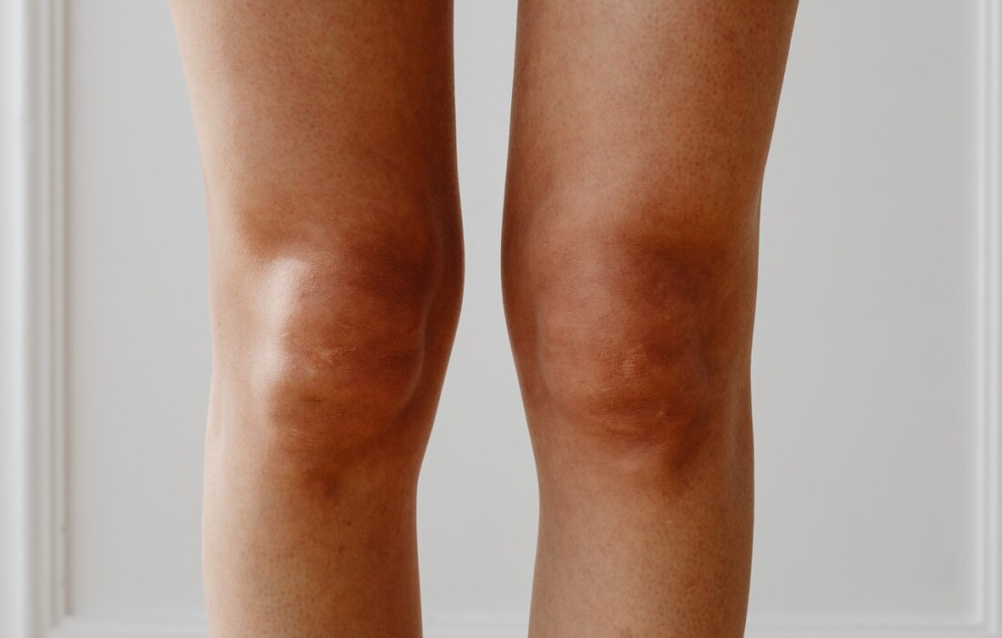 Как предотвратить старение локтей и коленей – рекомендации по уходу за кожей