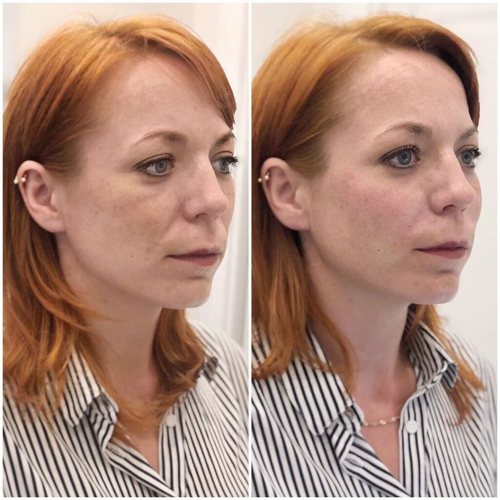 Омоложение лица Full face до и после